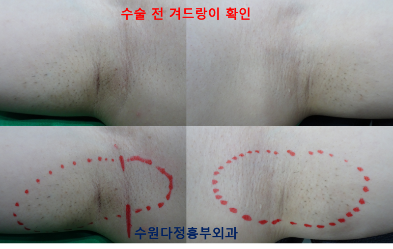 유전되는 겨드랑이 냄새 세 자매의 삼중요법 액취증 수술