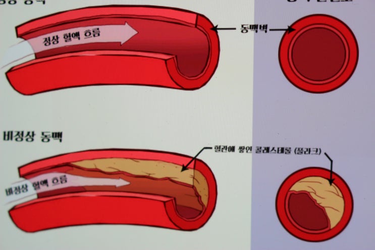  LDL, HDL 총 콜레스테롤 수치 왜 유지해야 할까?