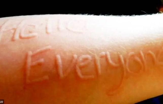 광주 피부묘기증 가볍게 넘기기 쉬운 피부질환 5