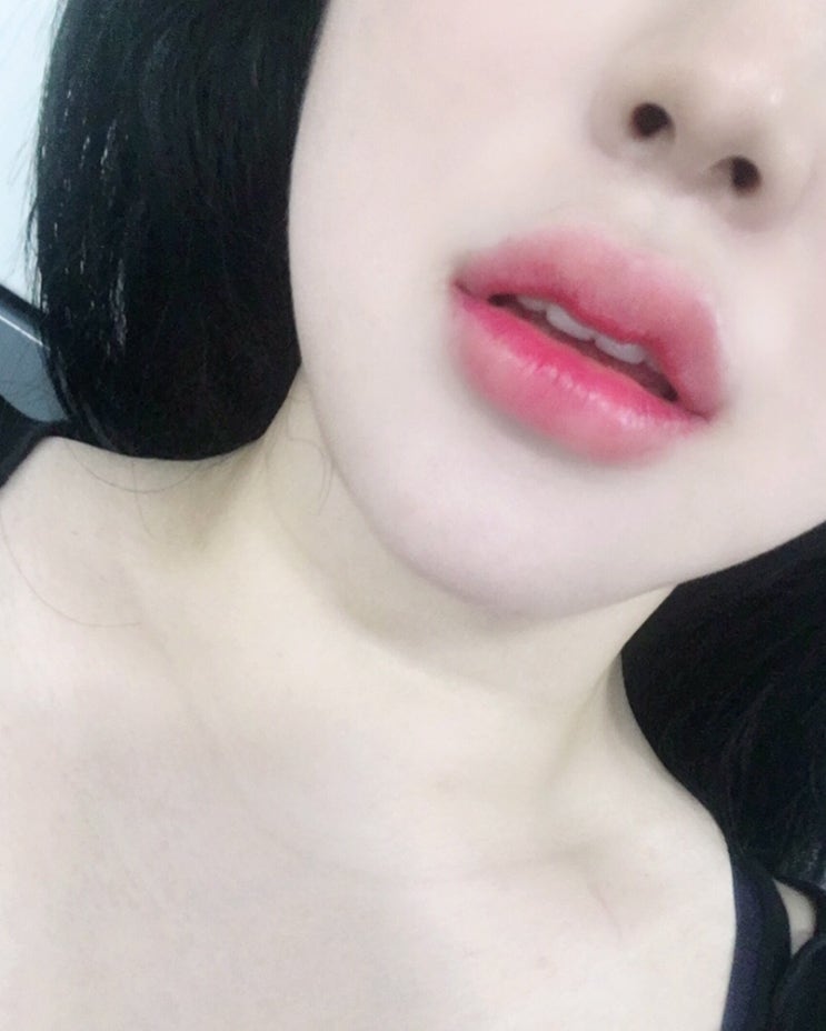  수원입술필러 후기️ 메디큐브클리닉 수원점 (완전맘에듬)