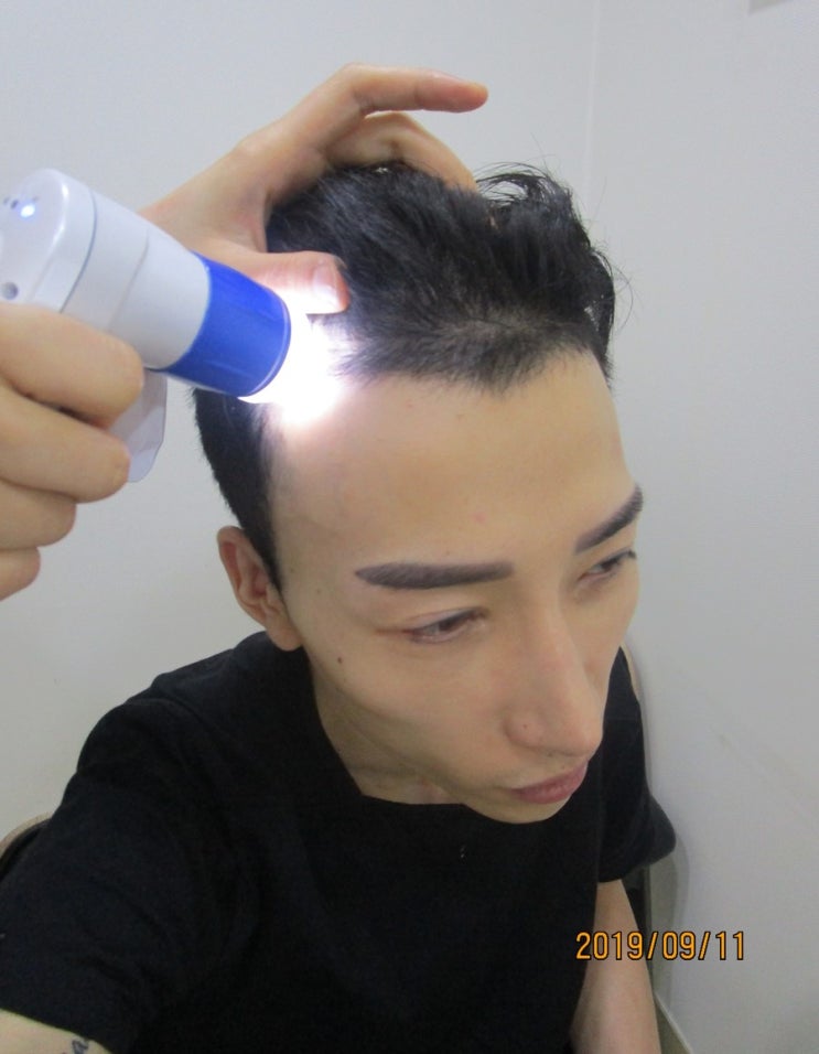  신림 탈모 WT메소드 스넬라에서 신림두피관리 리얼전후 후기