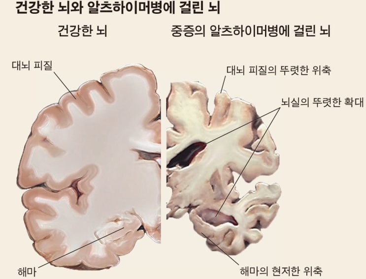  불면증과 망상장애 [제주 온기담은 한의원]