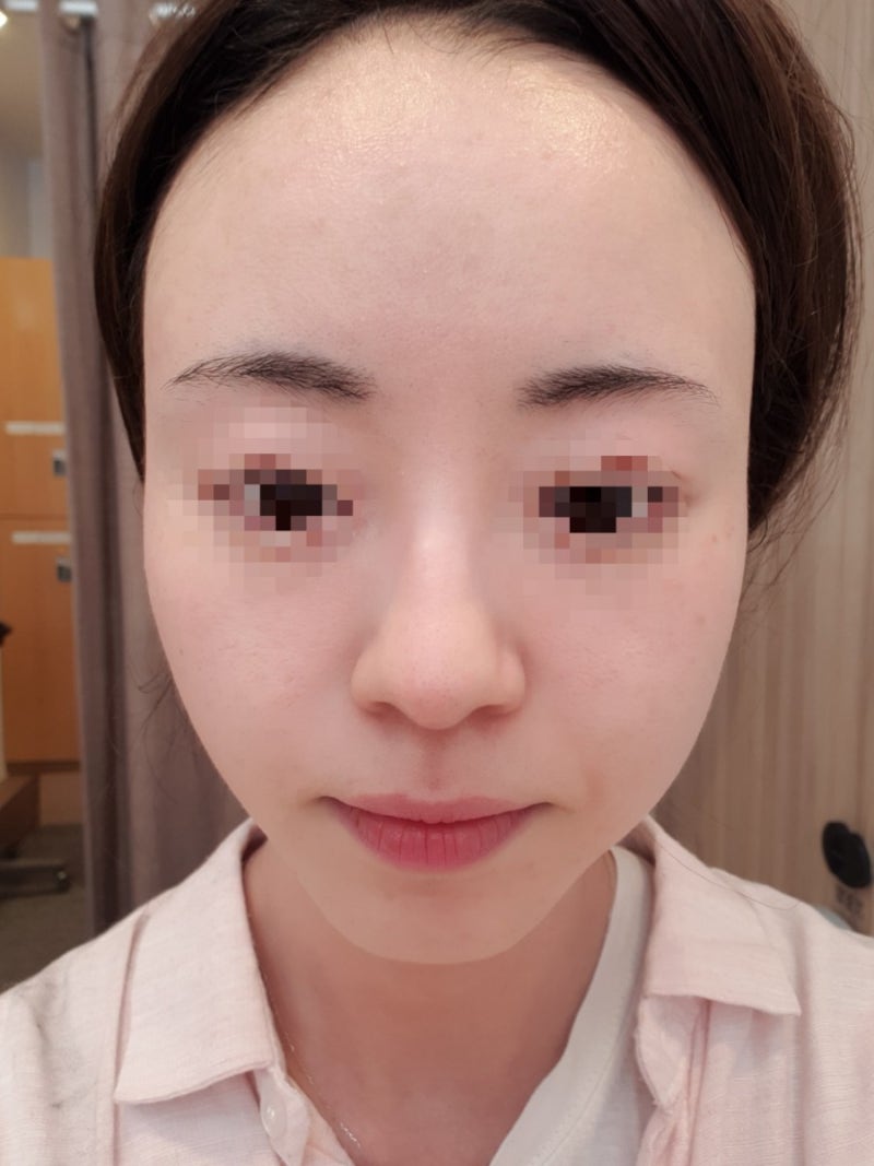 네오빔레이저+LDM효과관리가격 (강남피부과 기장여드름 평가)