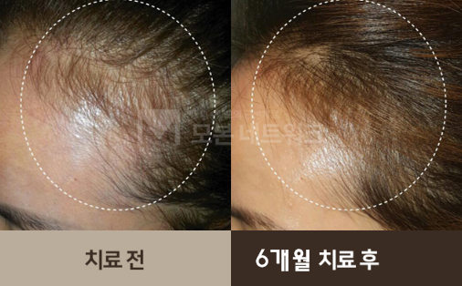 M자탈모,원형탈모,여성탈모 치료방법 2