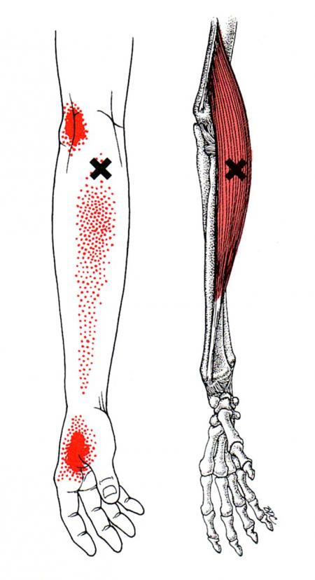  Brachioradialis syndrome