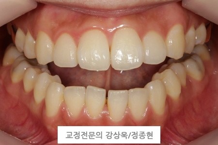  간단한 부분교정으로 하는 재교정치료 [서면교정치과,부산재교정치과]