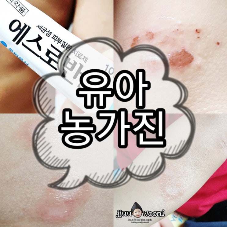 30개월~ 유아농가진 혐오주의 쌩고생 발병-증상-전염-완치까지 여름에발병하는 유아질병 에스로반연고사용후기 모기에물린후농가진 예민한아기피부 대처 30개월~ 유아농가진 혐오주의 쌩고생 발병-증상-전염-완치까지 여름에발병하는 유아질병 에스로반연고사용후기 모기에물린후농가진 예민한아기피부 대처