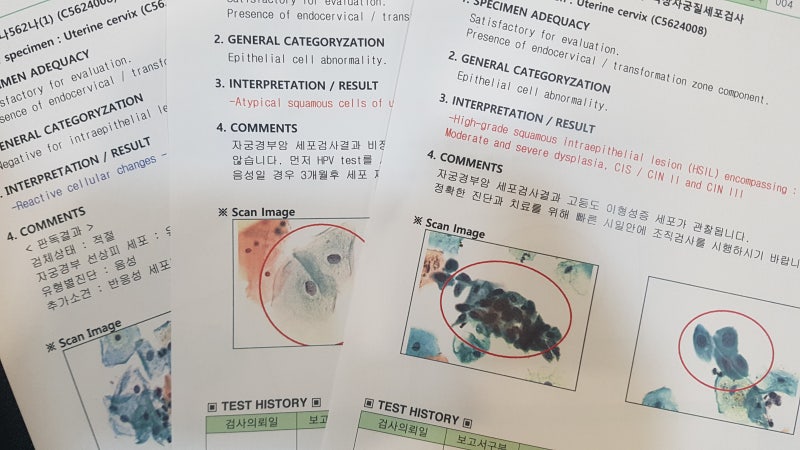 HPV 바이러스가 검출되면 자궁경부암? 자궁경부암 검사 결과지 보는 법! 4