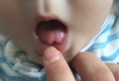  8개월 아기 ... 갑자기 설소대 수술을 하라고?? .... 저의 결정은 “안한다” 입니다