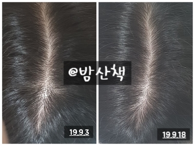  여성탈모치료제 엘크라넬 사용효과 부작용 후기(2019.09.7~2019.9.18)