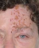  이마 대상포진 herpes zoster opthalmicus 대상포진예방접종