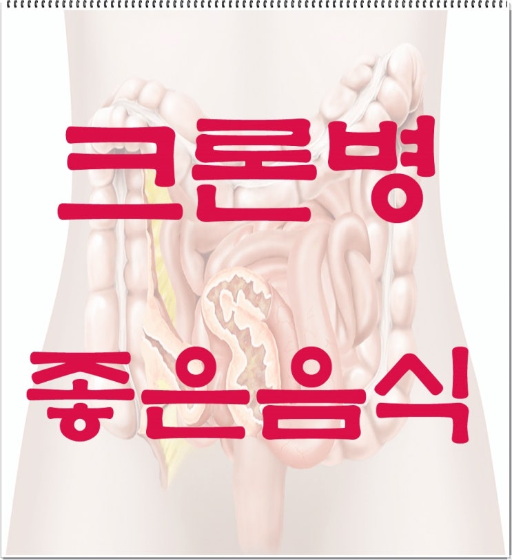  크론병에 좋은 음식 모든것 (윤종신씨 이야기)