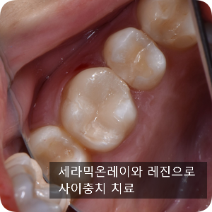  망원동 치과 어금니 사이 충치 치료방법은?