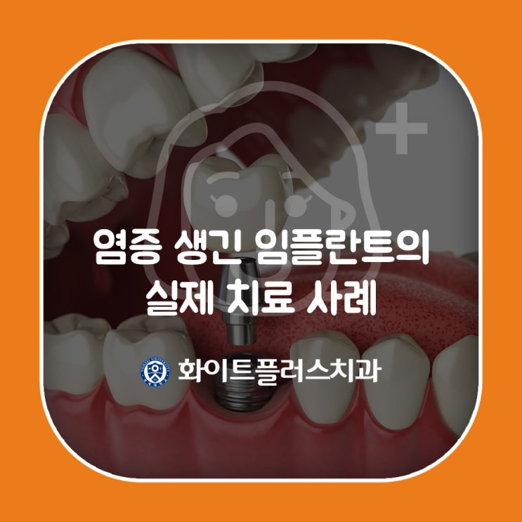  염증 생긴 임플란트의 실제 치료 사례
