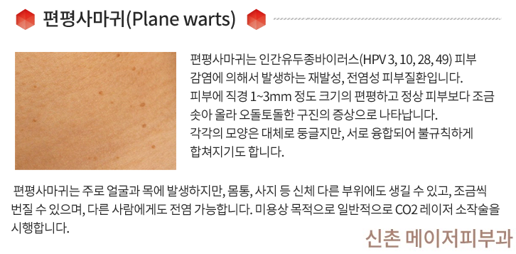 오목천동피부과, 쥐젖과 비립종을 깨끗이 제거하세요! 4