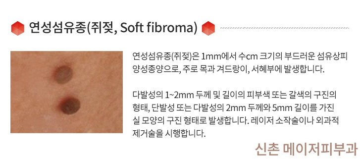 오목천동피부과, 쥐젖과 비립종을 깨끗이 제거하세요!