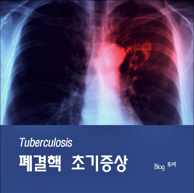 폐결핵 초기증상 꼭 챙겨야 할 좋은 음식