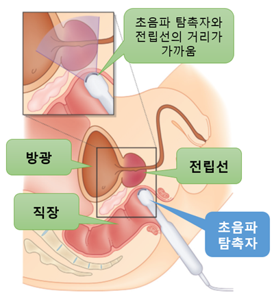 [울산 삼산동 비뇨기과] 전립선 비대증에서 전립선 초음파의 역할