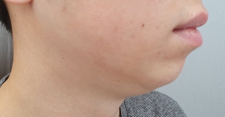 앞턱, 양악수술 전후, 남성, 무턱-이중턱을 제거하고 근육을 묶는 이유(바이오본드?)