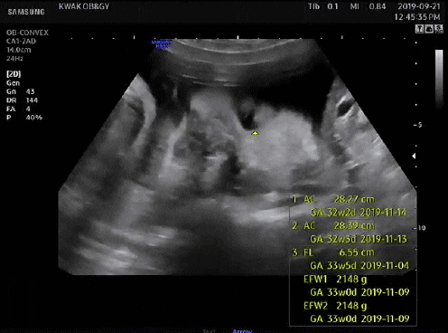 [임신후기 9개월] 33주 초음파 : 태아 몸무게 2.15kg, 머리크기 8.51cm, 머리카락, 눈 깜빡, 도리도리 