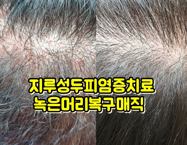 전주 남자 심한 곱슬머리 매직 후 유지기간 & 지루성두피염증 치료  후기