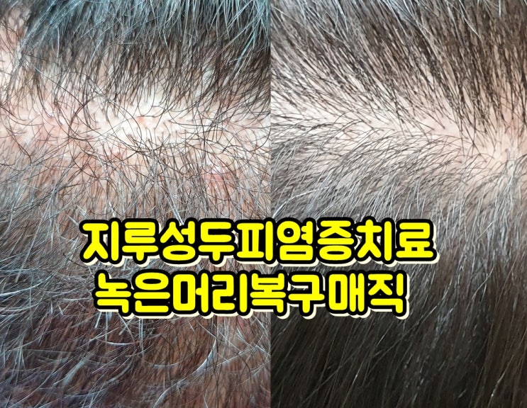  전주 남자 심한 곱슬머리 매직 후 유지기간 & 지루성두피염증 치료  후기
