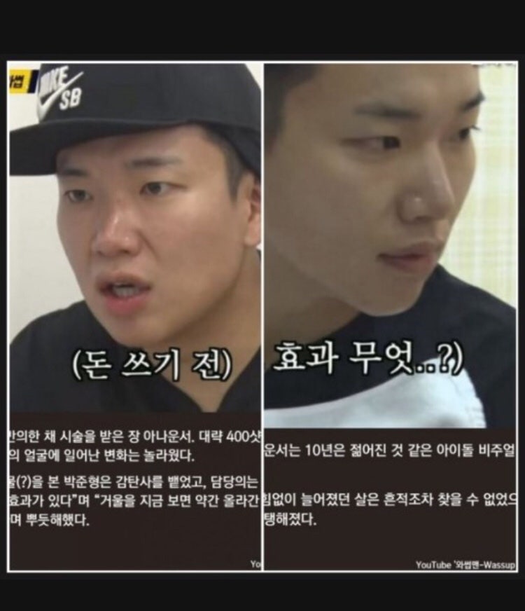 장성규 슈링크 전후