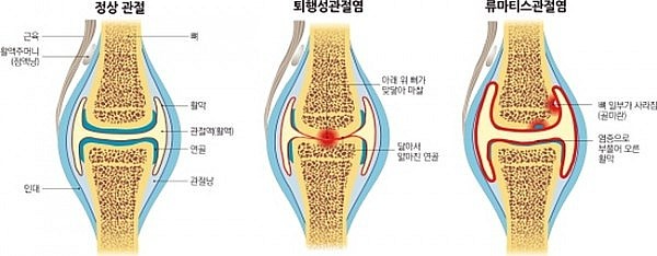  트리아이나 짐 TIP [부산pt 부산피티 해운대pt 장산pt 여자트레이너 부산여자트레이너 여자 운동 추천 ] 관절염을 예방하는 꿀팁
