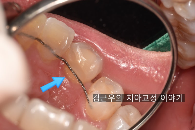 교정 유지장치가 떨어졌어요(유지장치 수리) : 네이버 블로그 교정 유지장치가 떨어졌어요(유지장치 수리) : 네이버 블로그