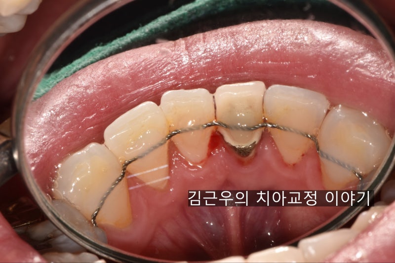 교정 유지장치가 떨어졌어요(유지장치 수리) : 네이버 블로그 교정 유지장치가 떨어졌어요(유지장치 수리) : 네이버 블로그