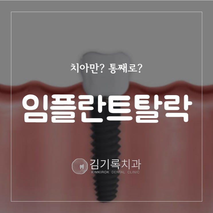 장안구임플란트재수술 임플란트가 빠졌어요! 임플란트 보철이나 나사가 빠졌을 때 대처방법