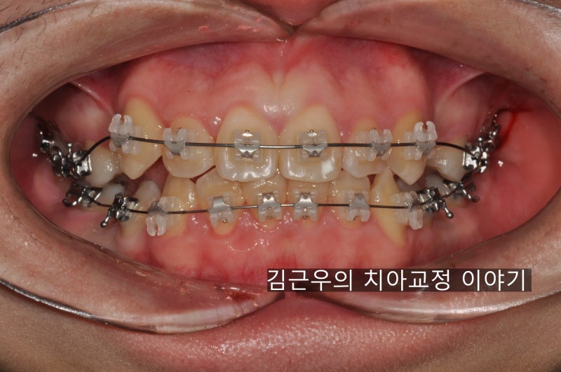 교정 유지장치가 떨어졌어요(유지장치 수리) : 네이버 블로그 교정 유지장치가 떨어졌어요(유지장치 수리) : 네이버 블로그