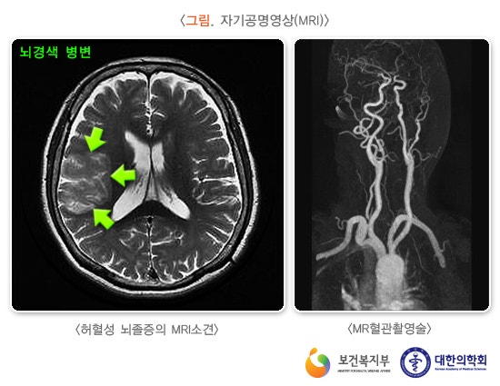 사전에 방비하는 급성 뇌경색 증상과 예방방법 13