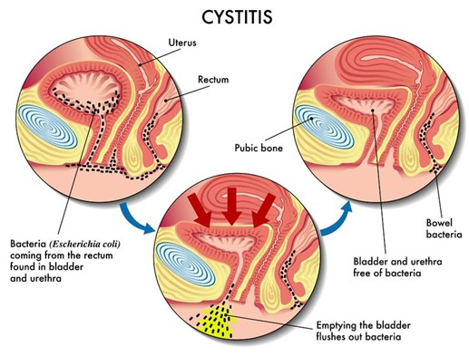여자 방광염 원인 '대장균 이동 감염과 성관계'