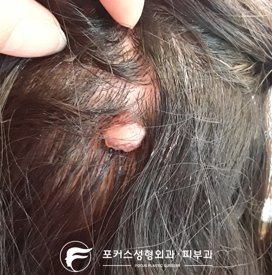 두피의 혹(화농성 육아종 - pyogenic granuloma) 두피의 혹(화농성 육아종 - pyogenic granuloma)