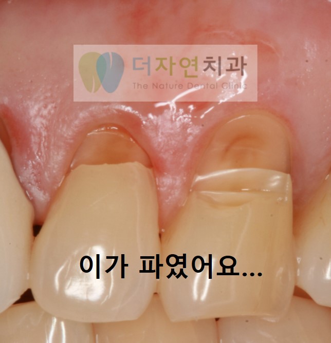 잇몸경계치아가 파였어요 [치경부마모증의 치료]