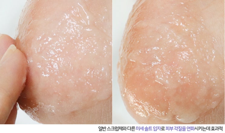  발 굳은살 제거 어렵지 않게 아가발로 대변신