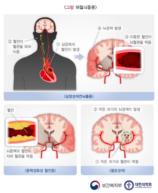 뇌경색의 증상과 원인은 무엇인가요?