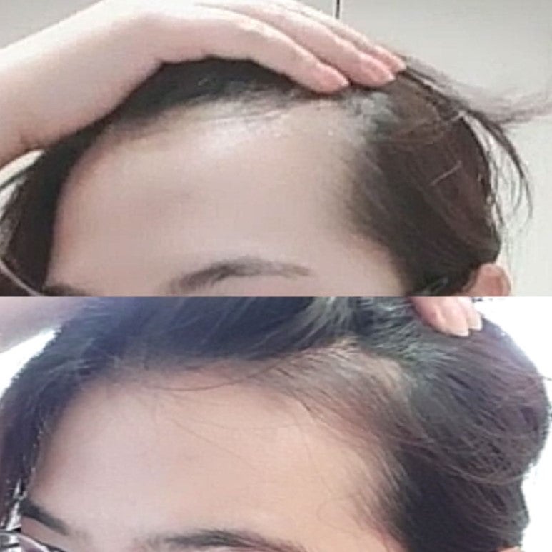 여자 M자 탈모증 초기증상예방법 루토닉앰플 2