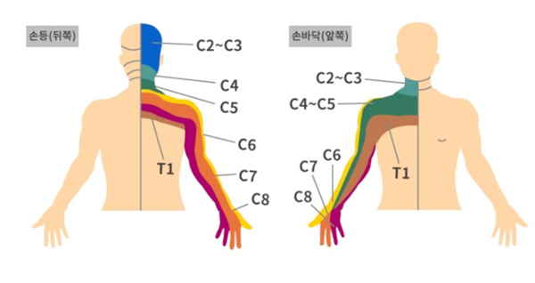 목 근육통, 목 디스크 손저림이 동반된다면?