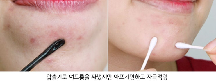  여드름 짜고난후 재발 방지하는 홈 케어 법