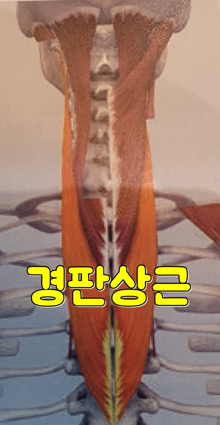 두판상근 허혈성 통증, 경판상근 힘줄 견인성 통증 신경포착