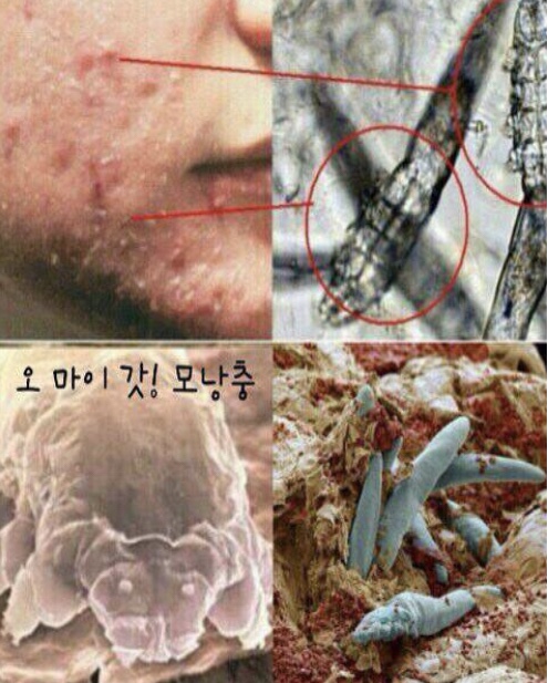  모낭충..?! 아토피, 여드름, 건성은 왜 안없어질까요,?!