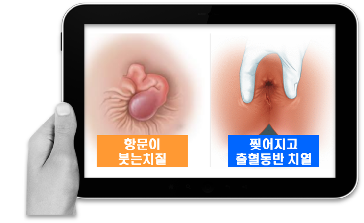  항문출혈과 통증 원인 치핵이냐 치열이냐? 구분과 치료