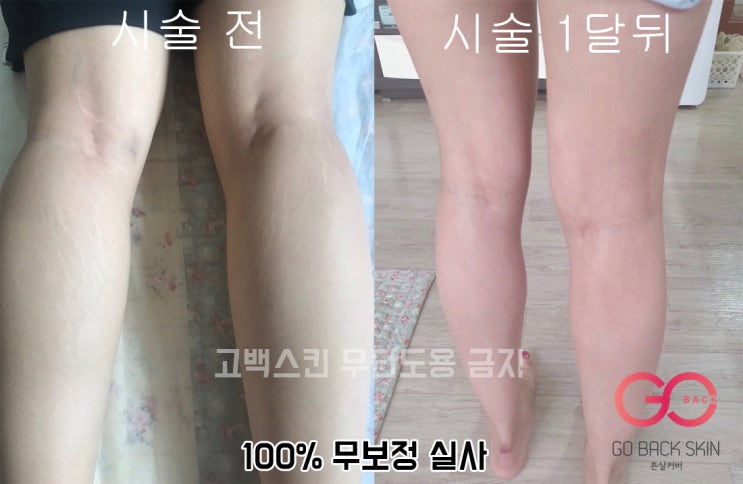  [고백스킨] 튼살타투 종아리 튼살 고민 해결! 종아리튼살 리얼 고객 후기 사진️