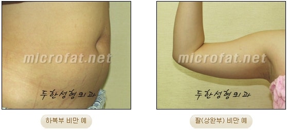 복부지방흡입국소마취로안전하게