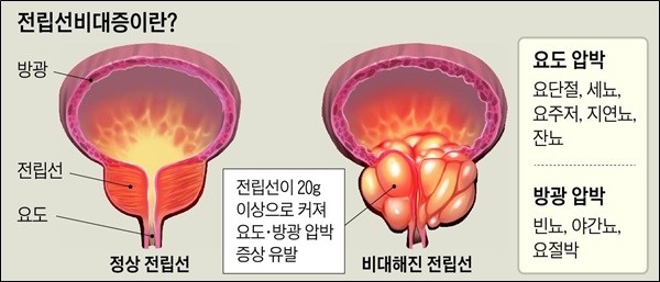  금성요폐 놔두면 콩팥기능 저하, 실신까지