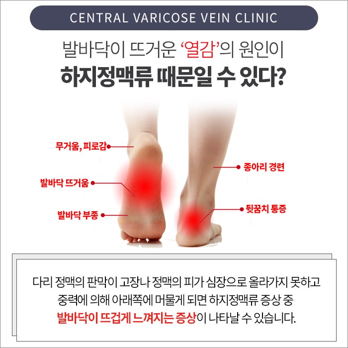 가능한 개선된 제목: 정맥류의 역할을 포함하여 뜨거운 발바닥의 원인과 증상을 이해한다