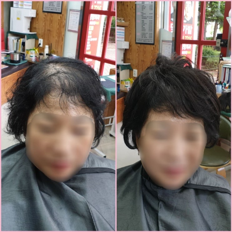  춘천부분가발 여자정수리가발 여자탑가발로 10년 젊어지세요~^^