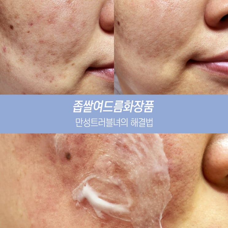  좁쌀여드름화장품 부터 완벽케어법까지